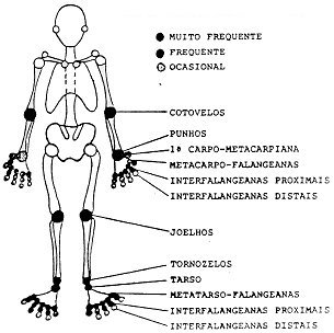 gota-envolvimento-articular